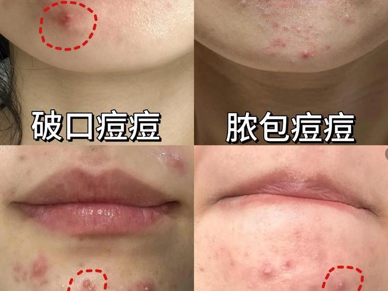 囊肿行痘痘怎么处理,囊肿痘痘怎么处理不留痘坑 囊肿行痘痘怎么处理,囊肿痘痘怎么处理不留痘坑