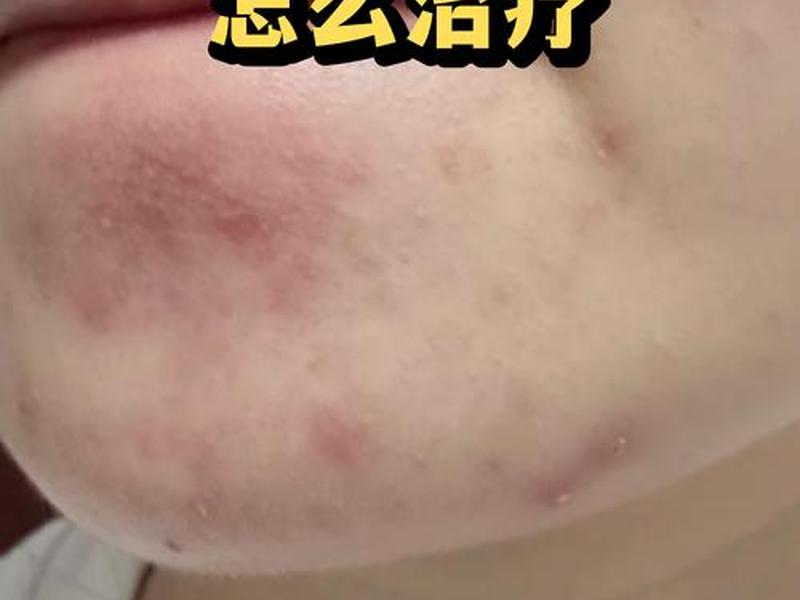 囊肿痘痘是什么原因引起的,该怎么治疗 囊肿痘痘是什么原因引起的,该怎么治疗女 囊肿痘痘是什么原因引起的,该怎么治疗 囊肿痘痘是什么原因引起的,该怎么治疗女