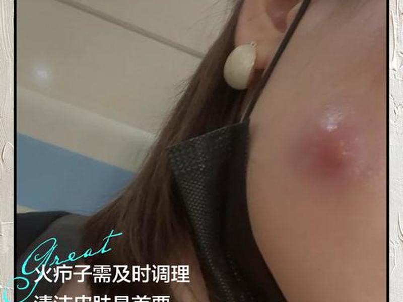 囊肿痘痘自己爆了流血(囊肿痘痘自己爆了流血怎么办) 囊肿痘痘自己爆了流血(囊肿痘痘自己爆了流血怎么办)