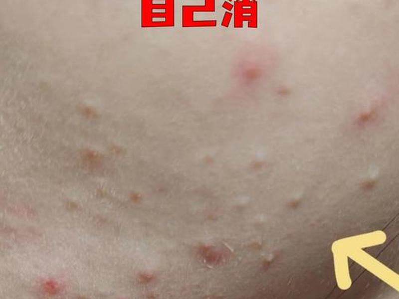 囊肿痘痘怎么好;囊肿的痘痘怎么好 囊肿痘痘怎么好;囊肿的痘痘怎么好