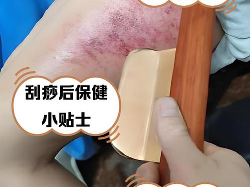 互相刮痧 - 互相刮痧什么意思 互相刮痧 - 互相刮痧什么意思