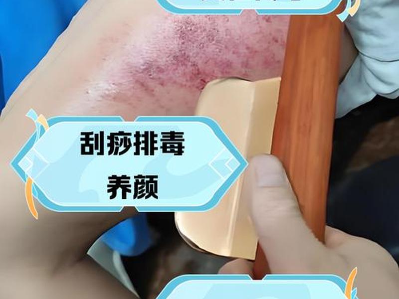 刮痧的适应人群;刮痧的适应人群包括 刮痧的适应人群;刮痧的适应人群包括