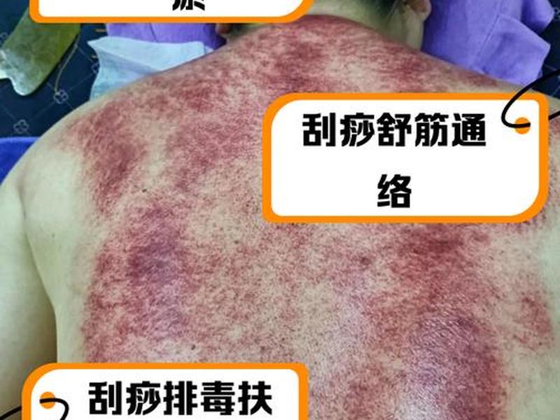 刮痧人际关系，刮痧人是什么意思