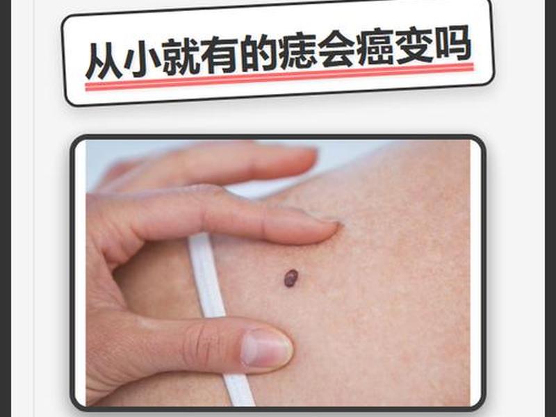 哪种类型的痣容易癌变 - 哪种类型的痣容易癌变呢