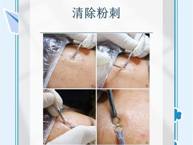 囊肿型痘痘怎么快速消下去;囊肿型痘痘怎么快速消下去图片 囊肿型痘痘怎么快速消下去;囊肿型痘痘怎么快速消下去图片