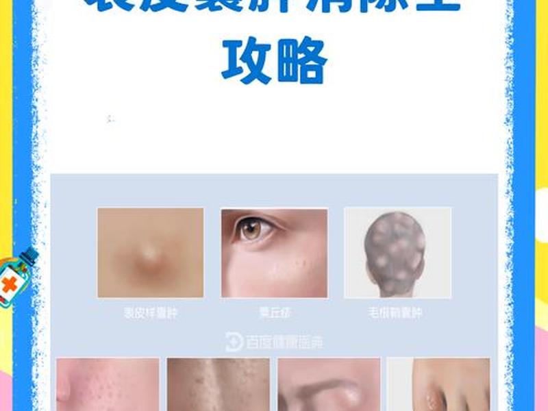 囊肿痘痘怎么消除最好的方法、囊肿痘痘怎么消除最好的方法图片 囊肿痘痘怎么消除最好的方法、囊肿痘痘怎么消除最好的方法图片