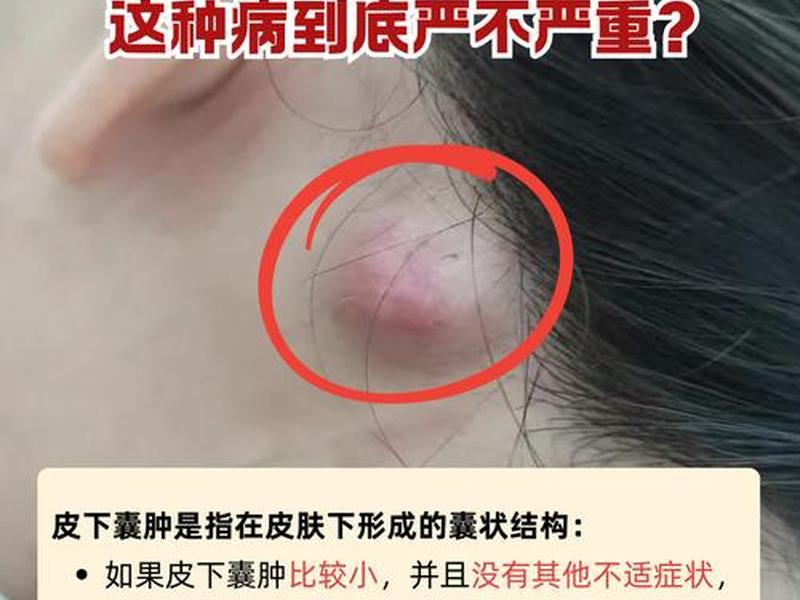 囊肿痘痘是什么原因引起的,该怎么治疗 囊肿痘痘是什么原因引起的,该怎么治疗女 囊肿痘痘是什么原因引起的,该怎么治疗 囊肿痘痘是什么原因引起的,该怎么治疗女