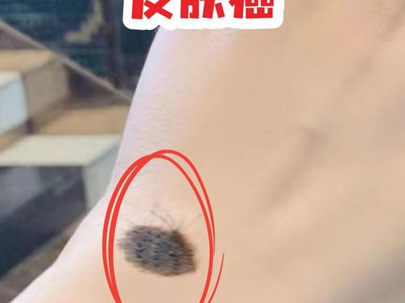 哪种类型的痣容易癌变 - 哪种类型的痣容易癌变呢