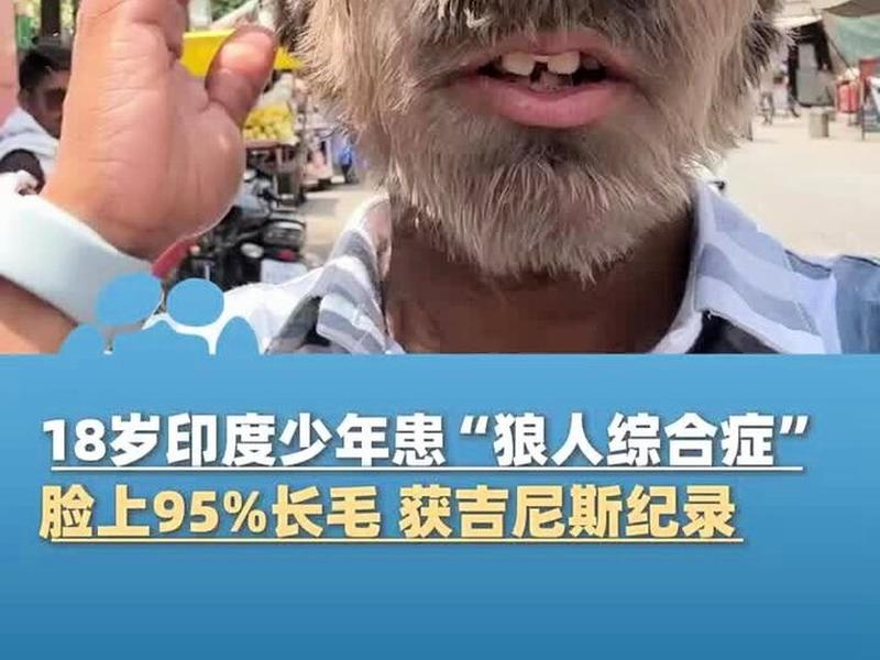 关于狼孩的真实案例，关于狼孩的真实案例视频
