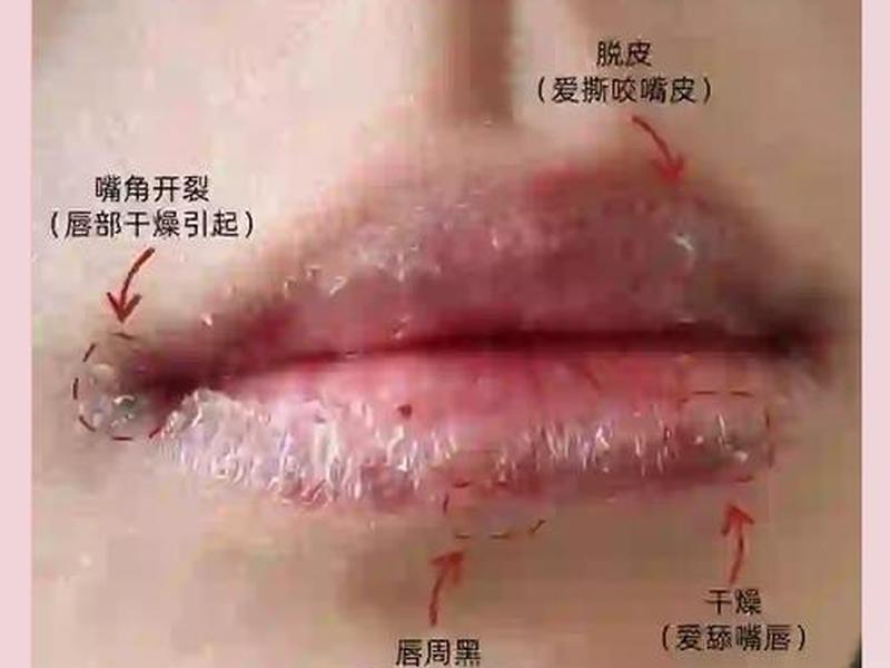 唇周干紧绷怎么处理 - 唇周干裂紧绷怎么处理 唇周干紧绷怎么处理 - 唇周干裂紧绷怎么处理