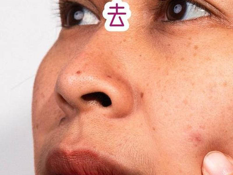 囊肿型痘痘消下去小妙招、囊肿型痘痘怎么消下去 囊肿型痘痘消下去小妙招、囊肿型痘痘怎么消下去
