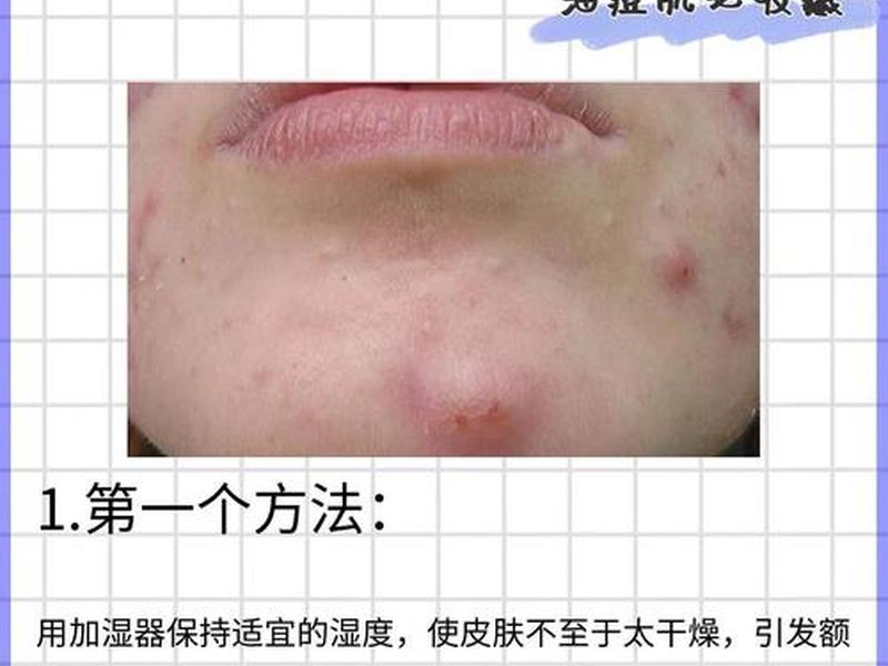 囊肿型痘痘怎么处理好得快 囊肿型痘痘怎么处理好得快一点 囊肿型痘痘怎么处理好得快 囊肿型痘痘怎么处理好得快一点