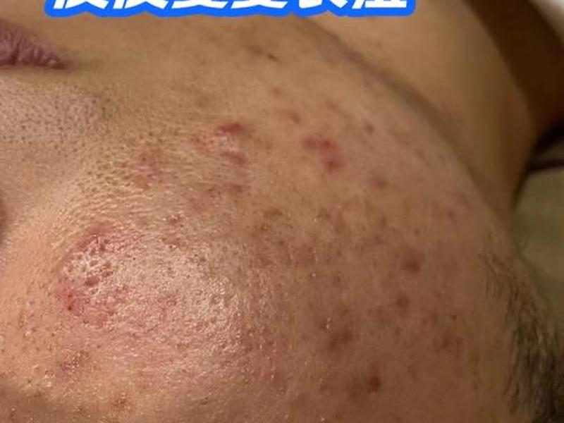 囊肿痘痘怎么好;囊肿的痘痘怎么好 囊肿痘痘怎么好;囊肿的痘痘怎么好