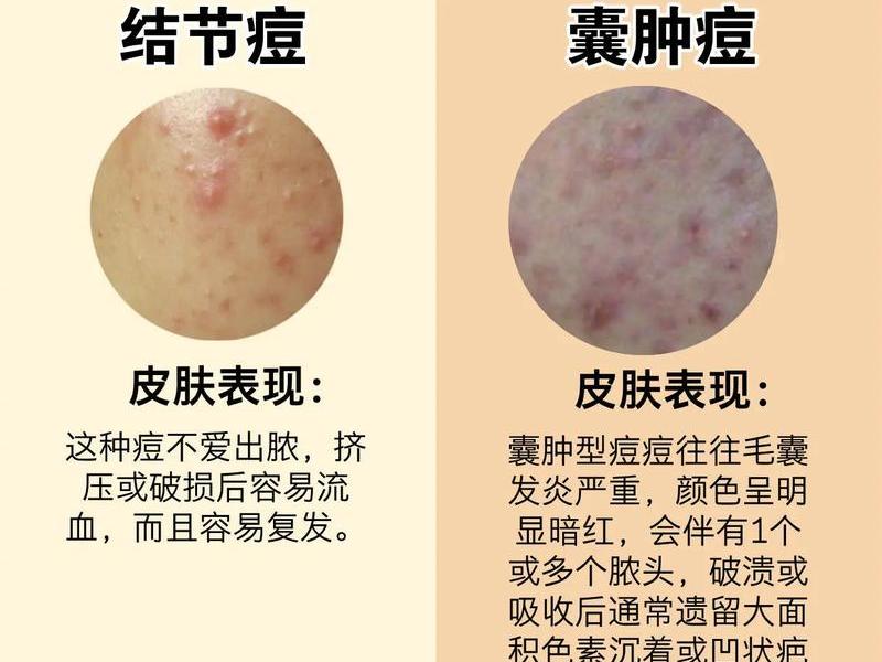 囊肿行痘痘怎么处理,囊肿痘痘怎么处理不留痘坑 囊肿行痘痘怎么处理,囊肿痘痘怎么处理不留痘坑