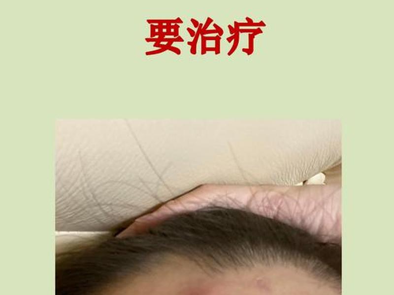 囊肿痘痘是什么原因引起的,该怎么治疗 囊肿痘痘是什么原因引起的,该怎么治疗女 囊肿痘痘是什么原因引起的,该怎么治疗 囊肿痘痘是什么原因引起的,该怎么治疗女
