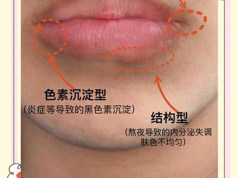 唇周老化松弛怎么改善、唇周老化松弛怎么改善图片 唇周老化松弛怎么改善、唇周老化松弛怎么改善图片
