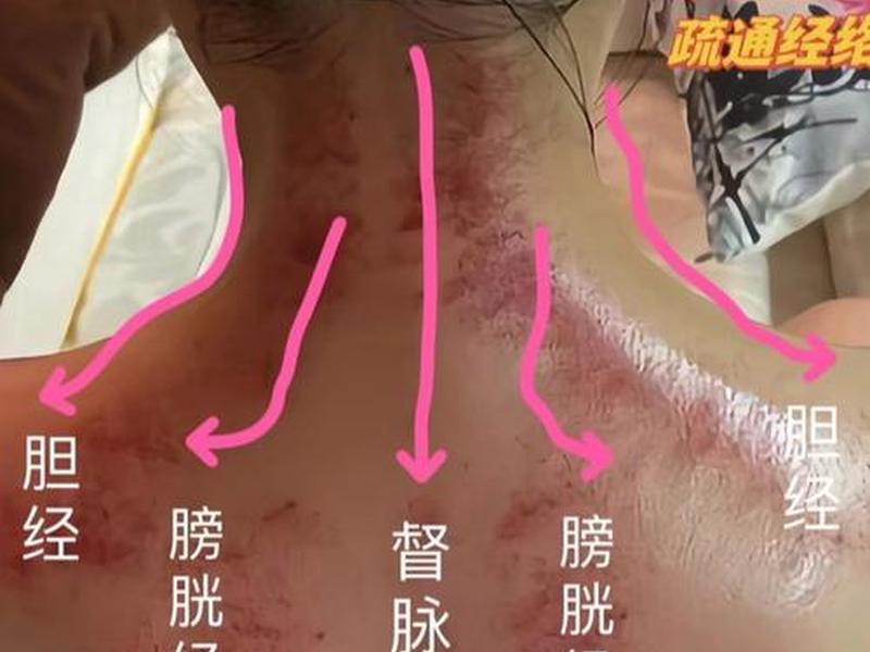 互相刮痧 - 互相刮痧什么意思 互相刮痧 - 互相刮痧什么意思