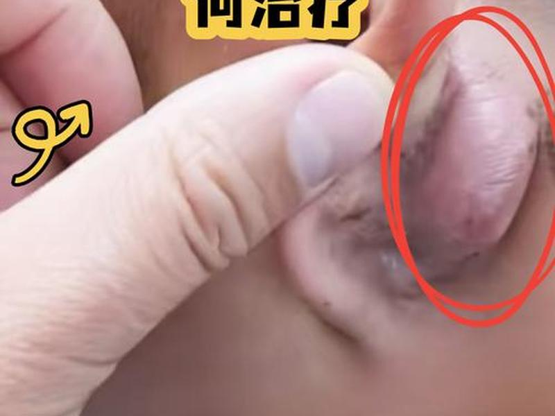囊肿痘痘如何治疗;囊肿痘痘如何治疗图片 囊肿痘痘如何治疗;囊肿痘痘如何治疗图片