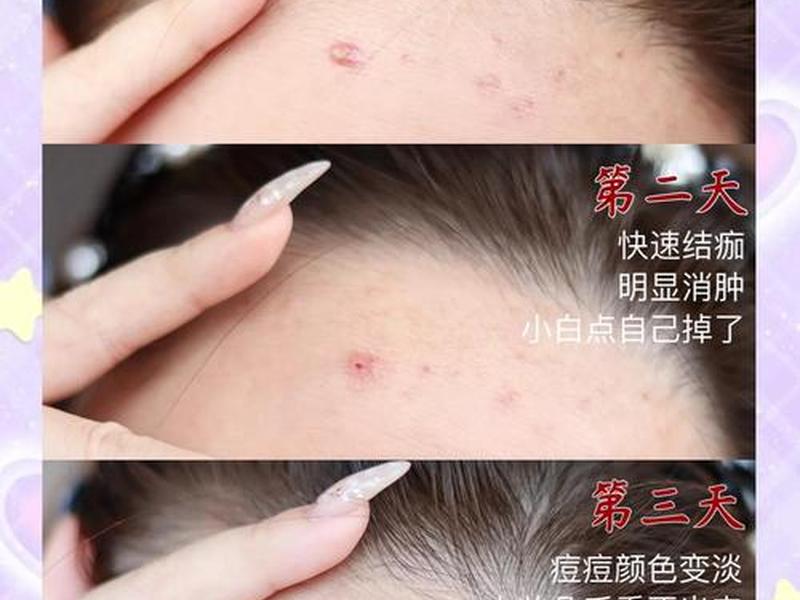 囊肿行痘痘怎么处理,囊肿痘痘怎么处理不留痘坑 囊肿行痘痘怎么处理,囊肿痘痘怎么处理不留痘坑