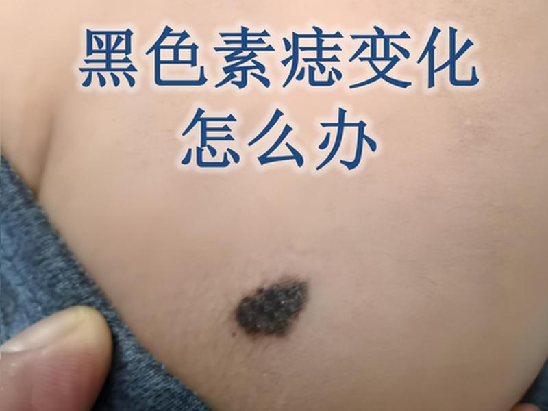 哪种类型的痣容易癌变 - 哪种类型的痣容易癌变呢