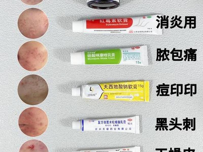 囊肿痘痘怎么消除最快最好;囊肿痘痘怎么消除最快最好的药 囊肿痘痘怎么消除最快最好;囊肿痘痘怎么消除最快最好的药