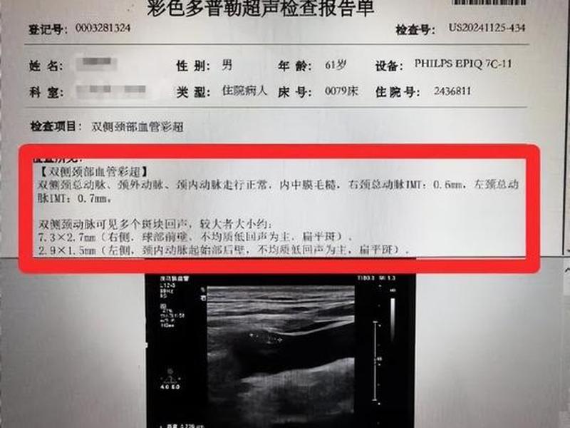 10个人九个人有颈部斑块;10个人九个人有颈部斑块主动脉斑块 10个人九个人有颈部斑块;10个人九个人有颈部斑块主动脉斑块