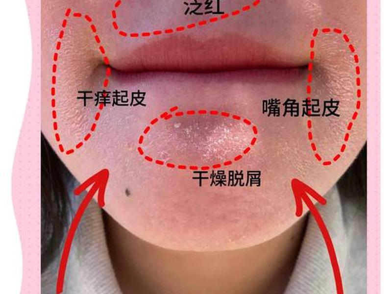 唇周干紧绷怎么处理 - 唇周干裂紧绷怎么处理 唇周干紧绷怎么处理 - 唇周干裂紧绷怎么处理