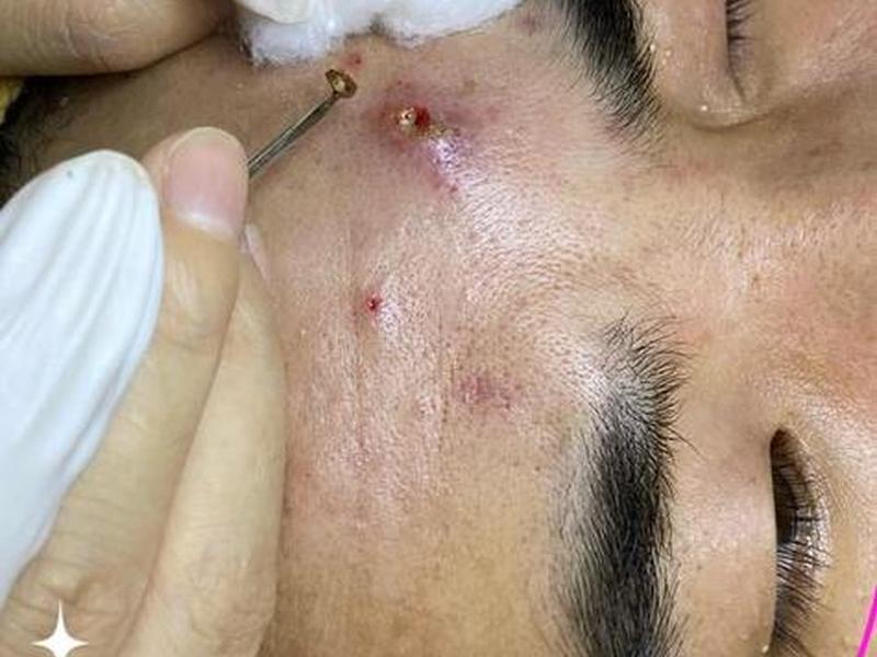 囊肿痘痘怎么消除用医美(囊肿痘痘怎么消除用医美方法) 囊肿痘痘怎么消除用医美(囊肿痘痘怎么消除用医美方法)