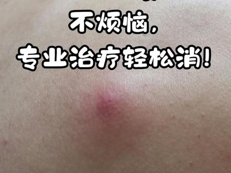囊肿痘痘怎么消除最好的方法、囊肿痘痘怎么消除最好的方法图片 囊肿痘痘怎么消除最好的方法、囊肿痘痘怎么消除最好的方法图片
