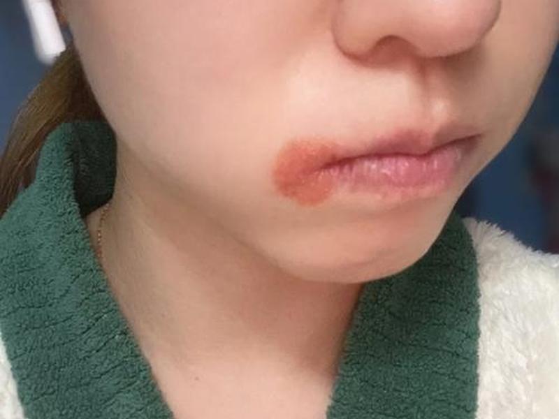 唇周紧绷是什么原因、唇周紧绷发痒是怎么回事
