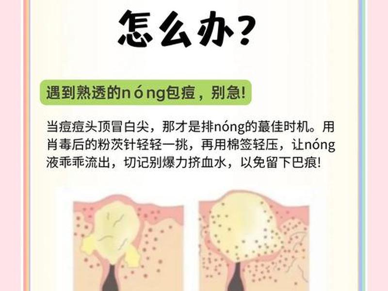 囊肿型痘痘怎么处理好得快 囊肿型痘痘怎么处理好得快一点 囊肿型痘痘怎么处理好得快 囊肿型痘痘怎么处理好得快一点